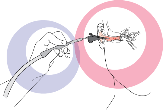 Ear Wax Removal Using Microsuction